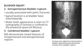 MCU, RGU and their interpretation in abnormalities of urinary bladder ...