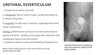 Utricular Cyst Rgu MCU, RGU and their interpretation in abnormalities of urinary bladder ...