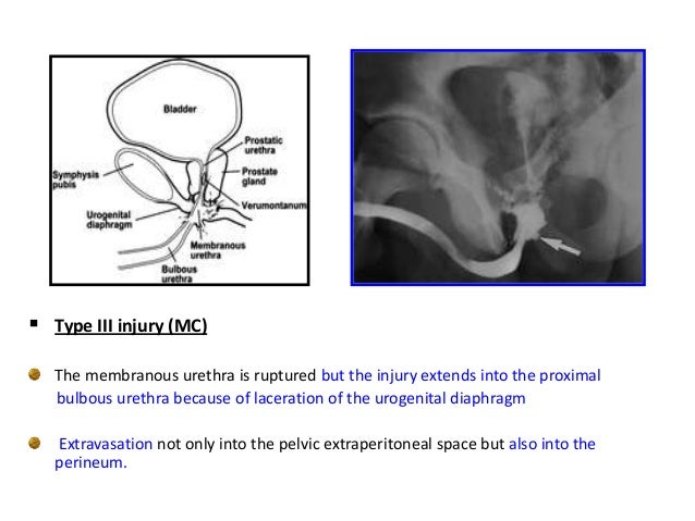 RGU MCU and its interpretation in pathology of Urinary Bladder & Uret…