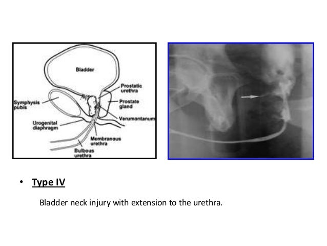 RGU MCU and its interpretation in pathology of Urinary Bladder & Uret…