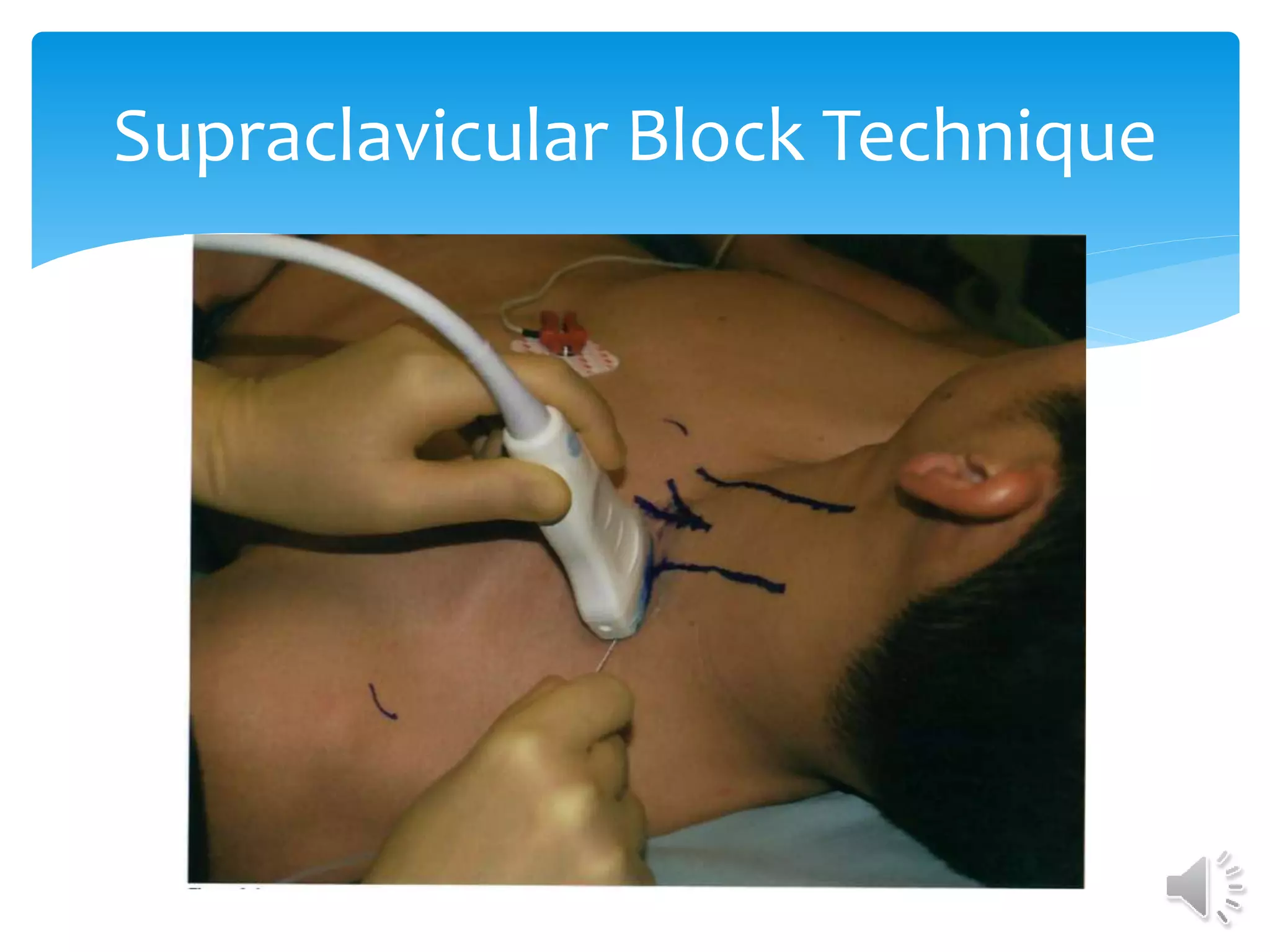 Supraclavicular Block Technique
 