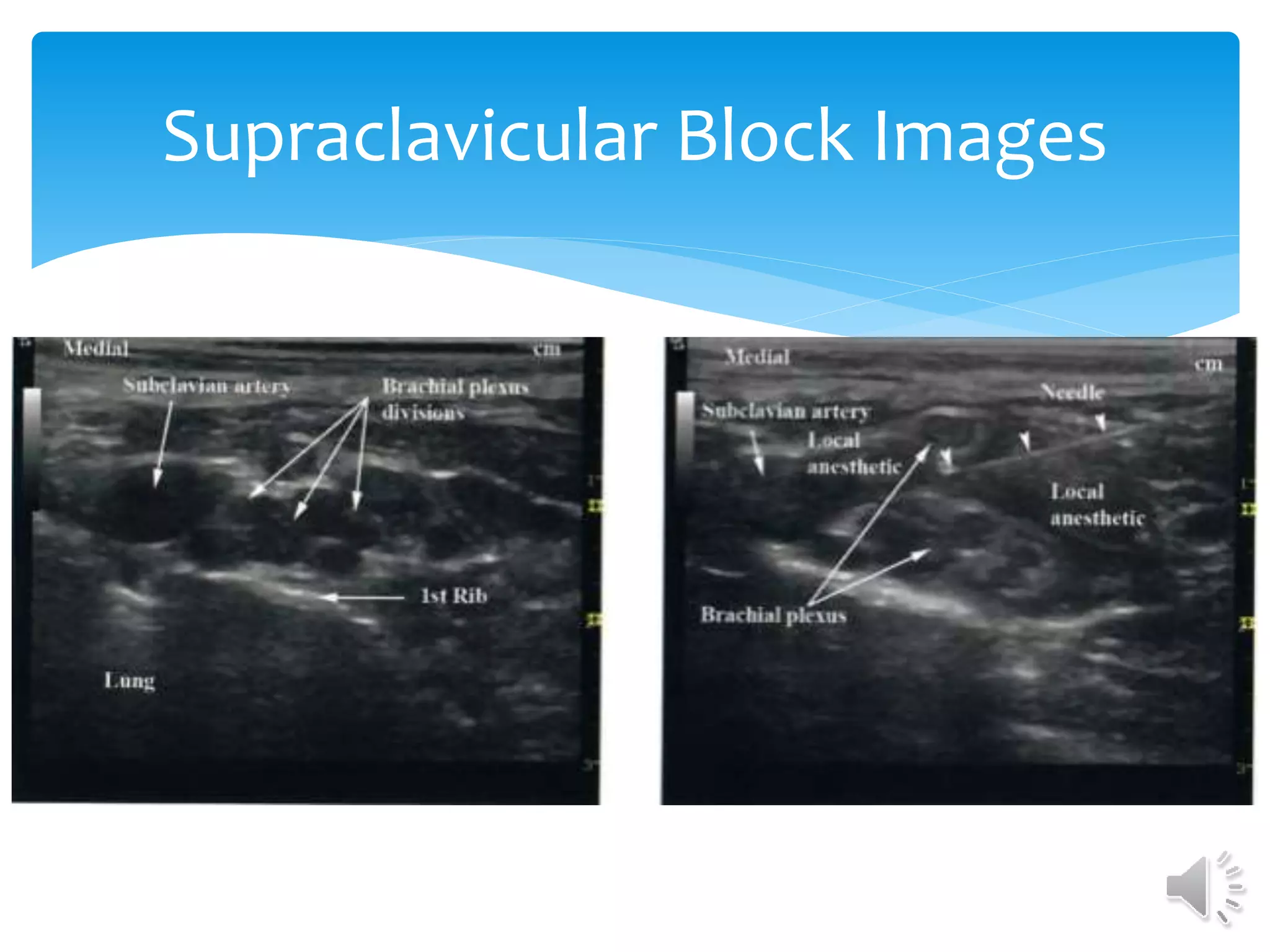 Supraclavicular Block Images
 