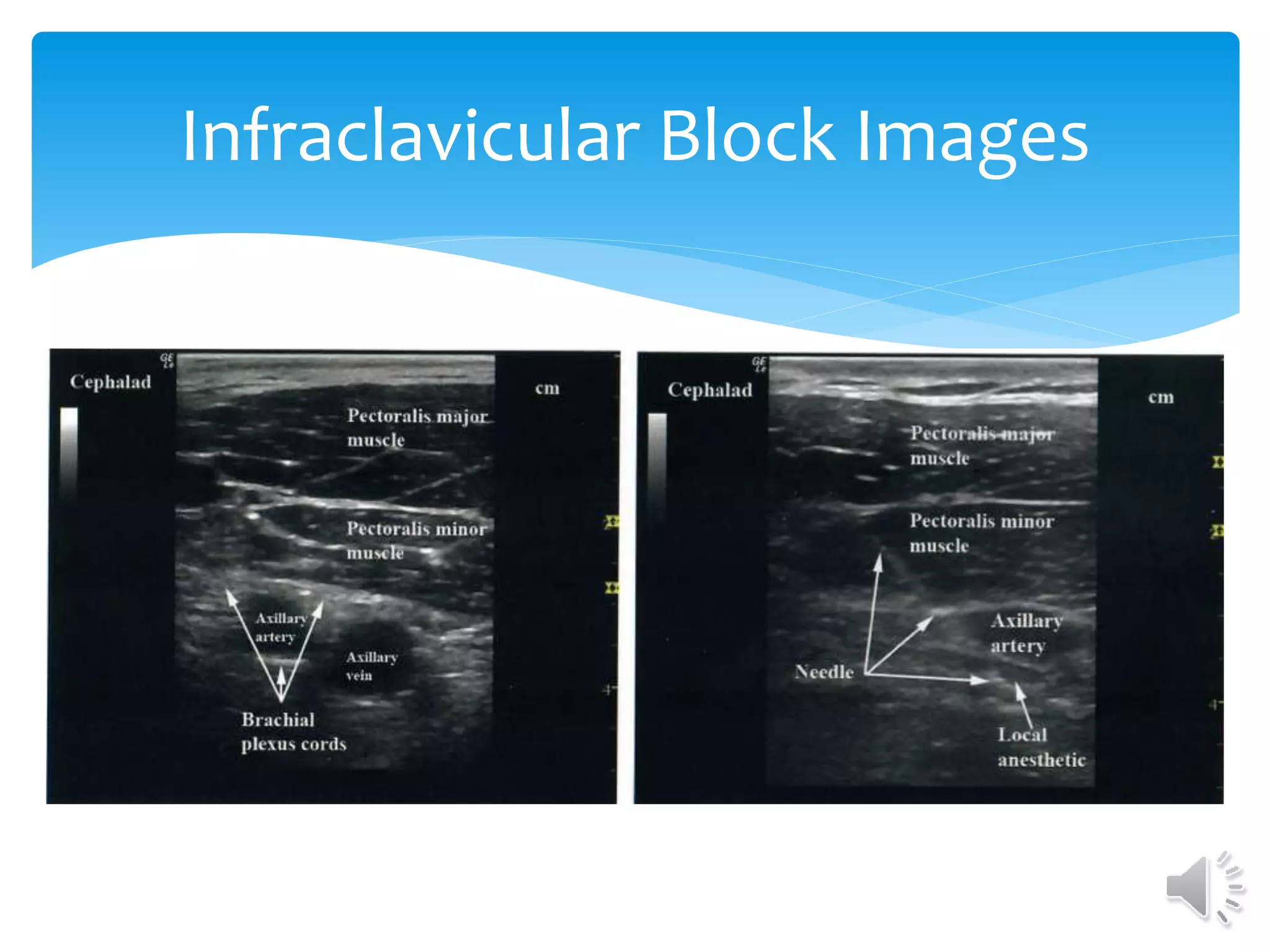 Infraclavicular Block Images
 