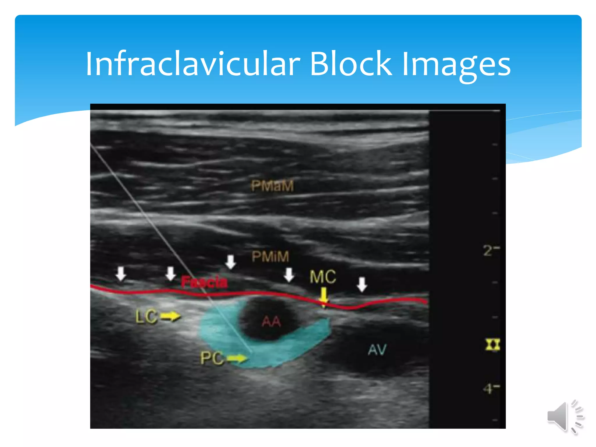 Infraclavicular Block Images
 