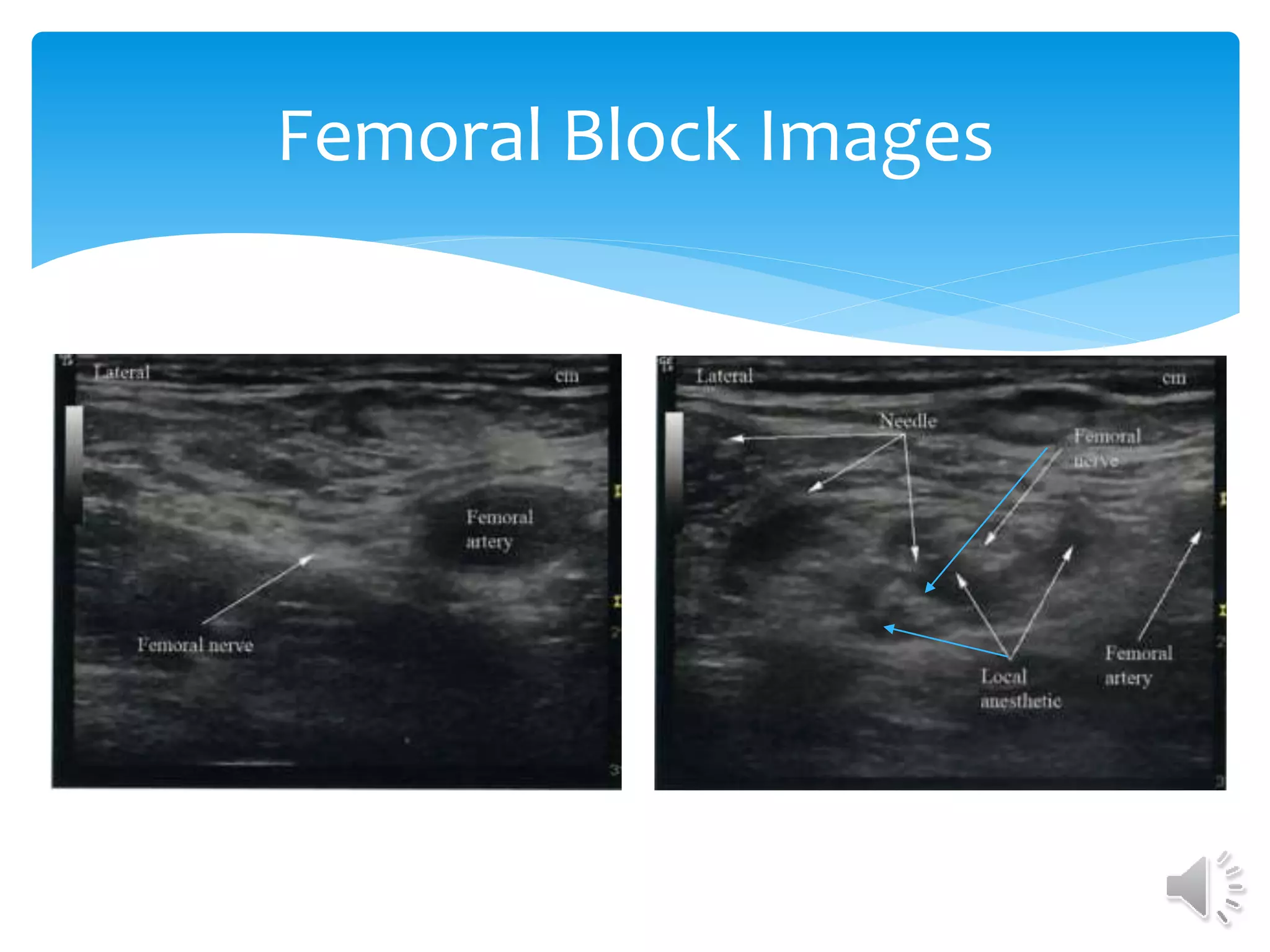 Femoral Block Images
 