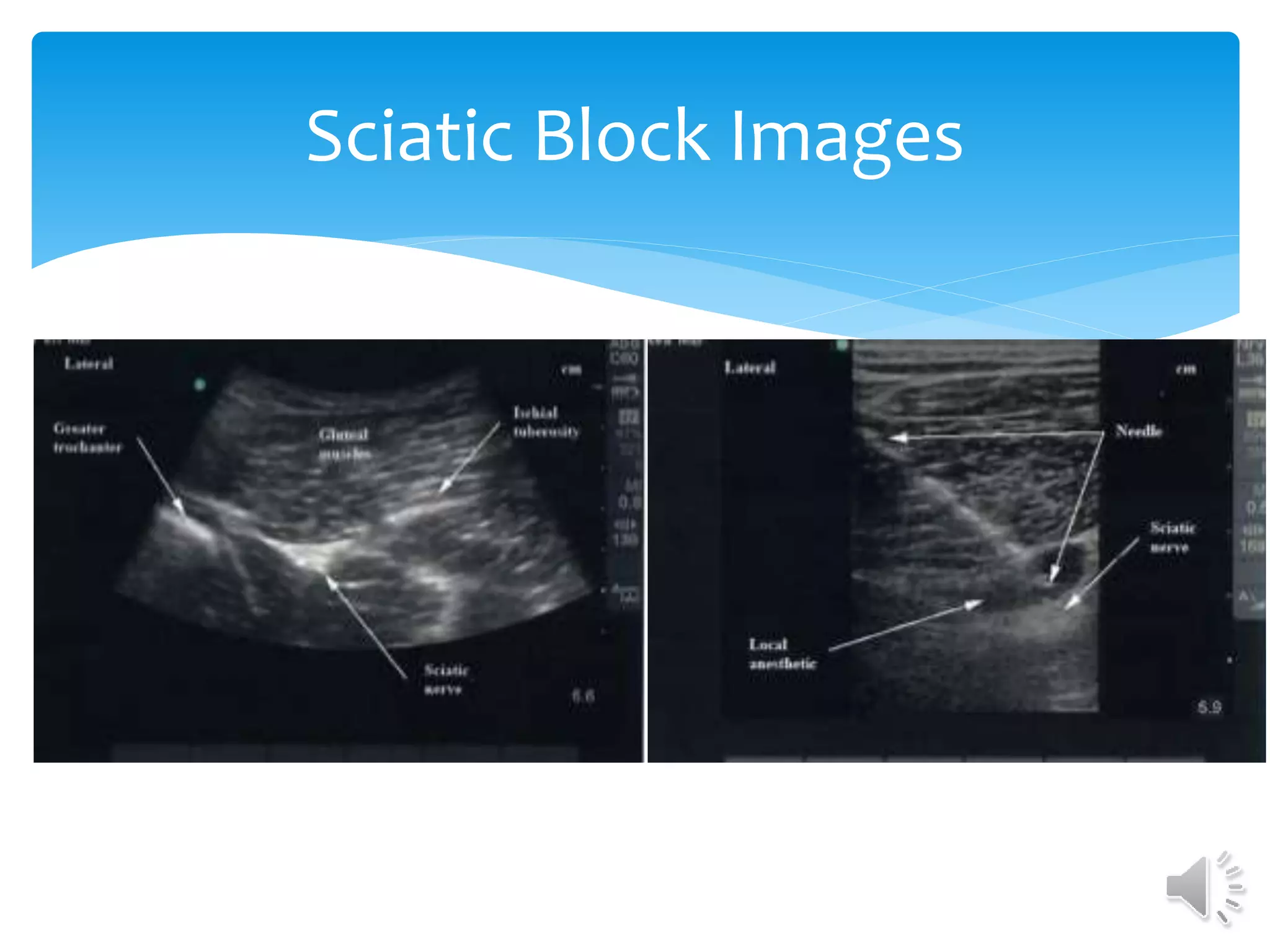 Sciatic Block Images
 