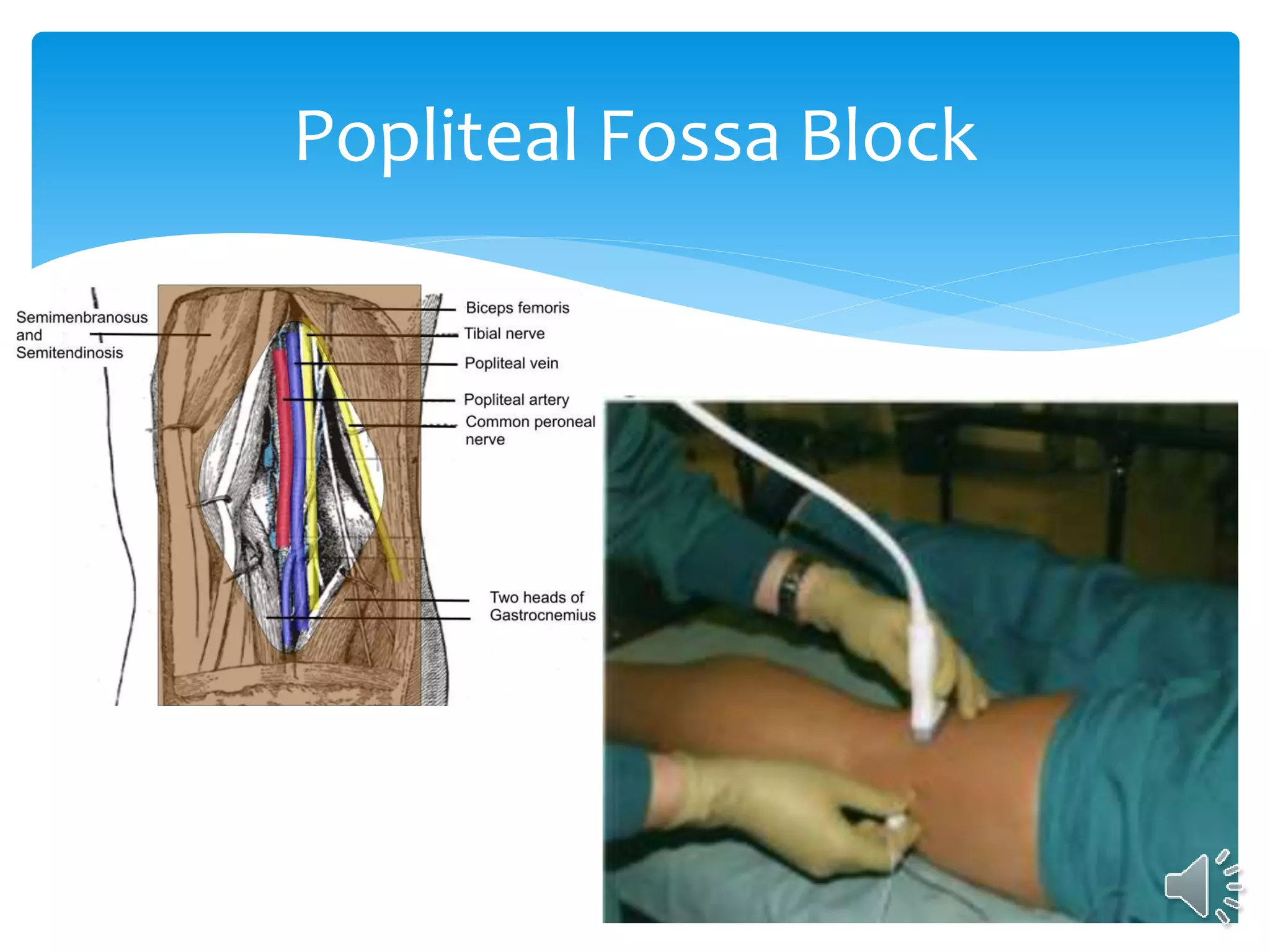 Popliteal Fossa Block
 