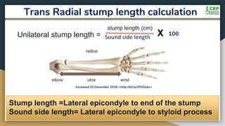 Trans Radial stump length calculation
Sound side length
Accessed 02 December 2018 <http://bit.ly/2PhGnkv>
stump length (cm)
100Unilateral stump length =
Stump length =Lateral epicondyle to end of the stump
Sound side length= Lateral epicondyle to styloid process
 