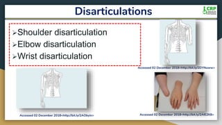 Disarticulations
Shoulder disarticulation
Elbow disarticulation
Wrist disarticulation
Accessed 02 December 2018<http://bit.ly/2AIE2K8>Accessed 02 December 2018<http://bit.ly/2AObyin>
Accessed 02 December 2018<http://bit.ly/2DYNuww>
 