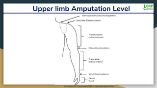 Upper limb Amputation Level
Accessed 02 December2018 < http://bit.do/eCdHd>
 