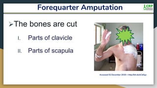 Forequarter Amputation
The bones are cut
I. Parts of clavicle
II. Parts of scapula
Accessed 02 December 2018 < http://bit.do/eCdGg>
 