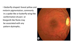 MACULAR DYSTROPHY | PPTX
