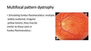 MACULAR DYSTROPHY | PPTX