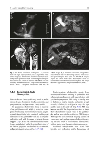 Thiasis mdct-and-mr-imaging-of-acute-abdomen_compress.pdf