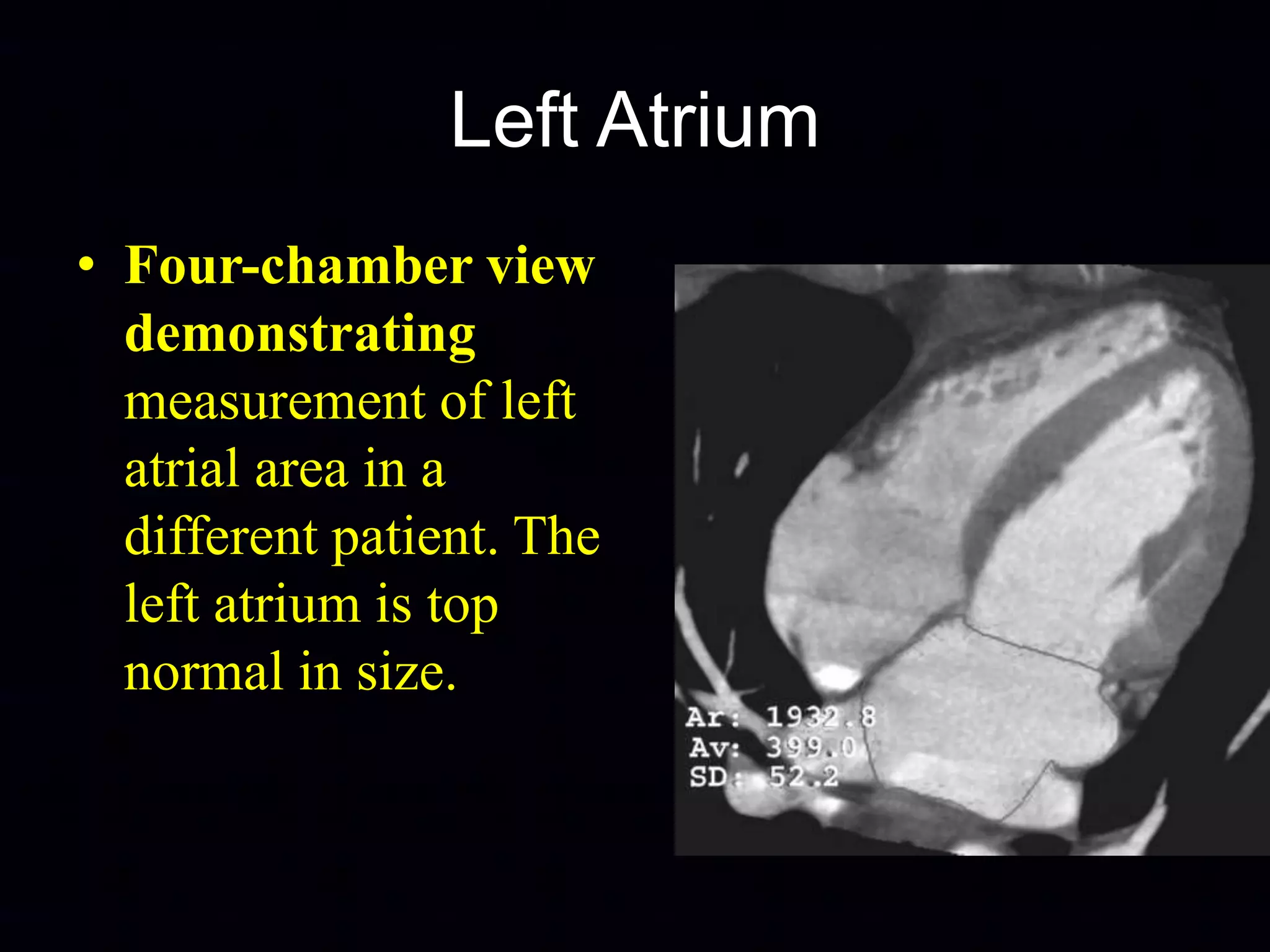 Normal Atrium Area Size MDCT Anatomy of Heart Dr. Muhammad Bin Zulfiqar | PPTX