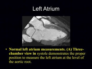 Normal Atrium Area Size MDCT Anatomy of Heart Dr. Muhammad Bin Zulfiqar | PPTX