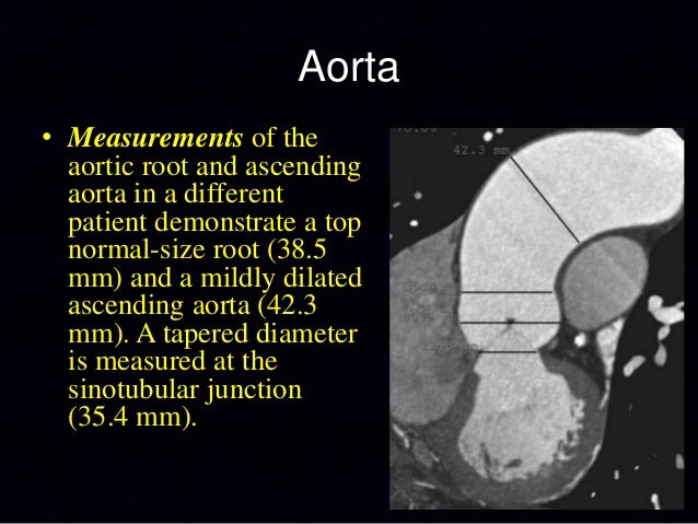 how to measure ascending aorta on ct