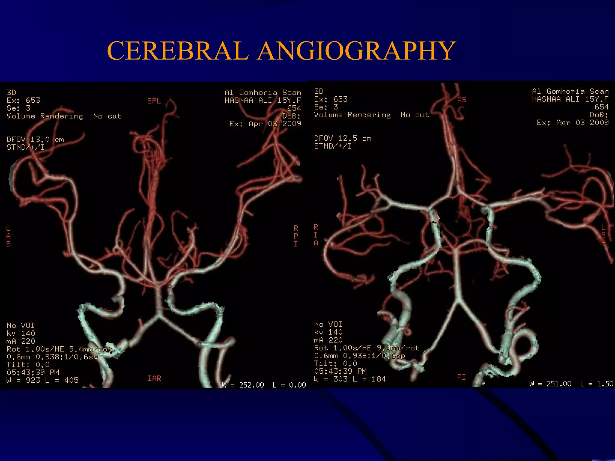 CEREBRAL ANGIOGRAPHY
 