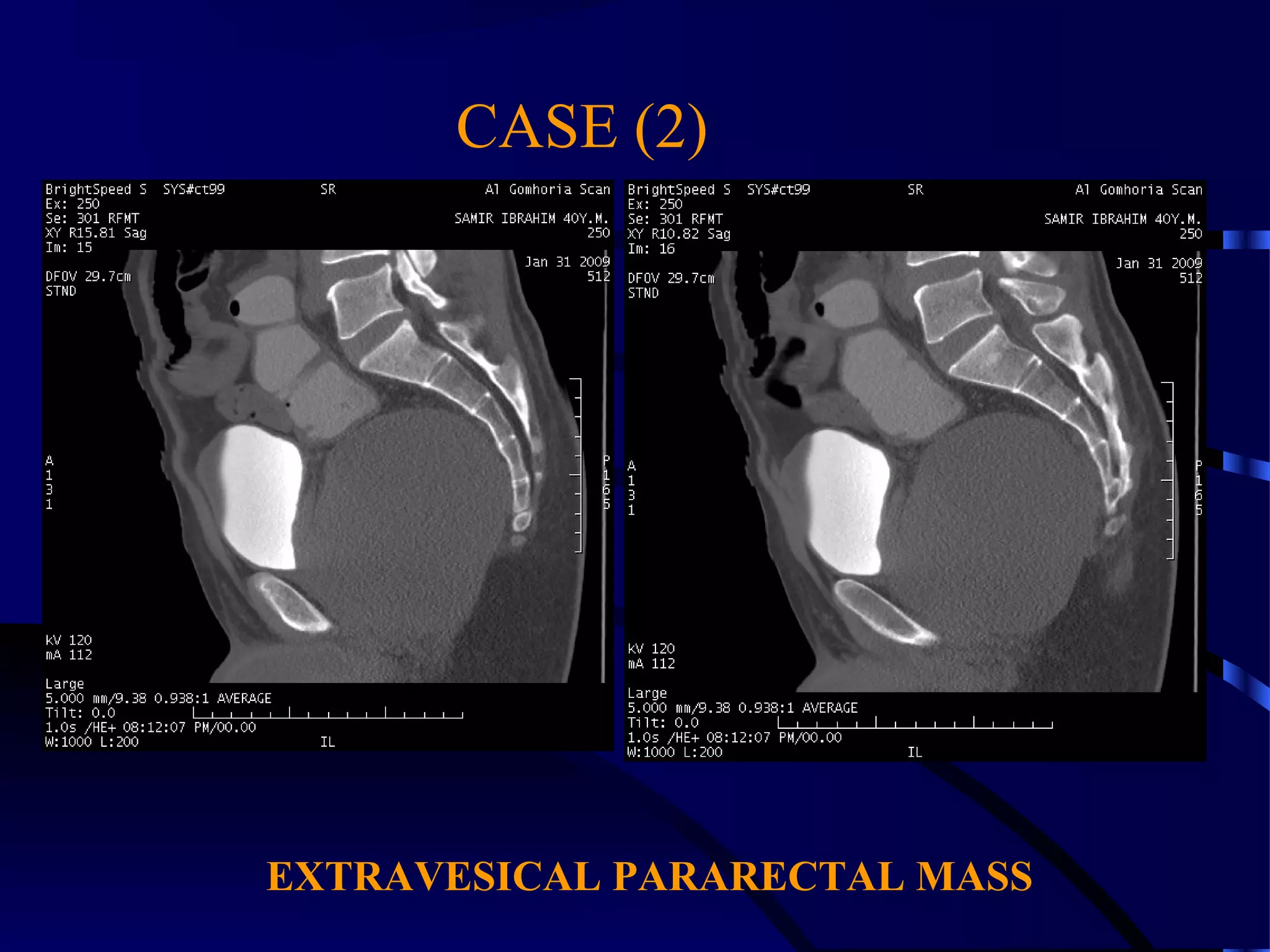 CASE (2)
EXTRAVESICAL PARARECTAL MASS
 