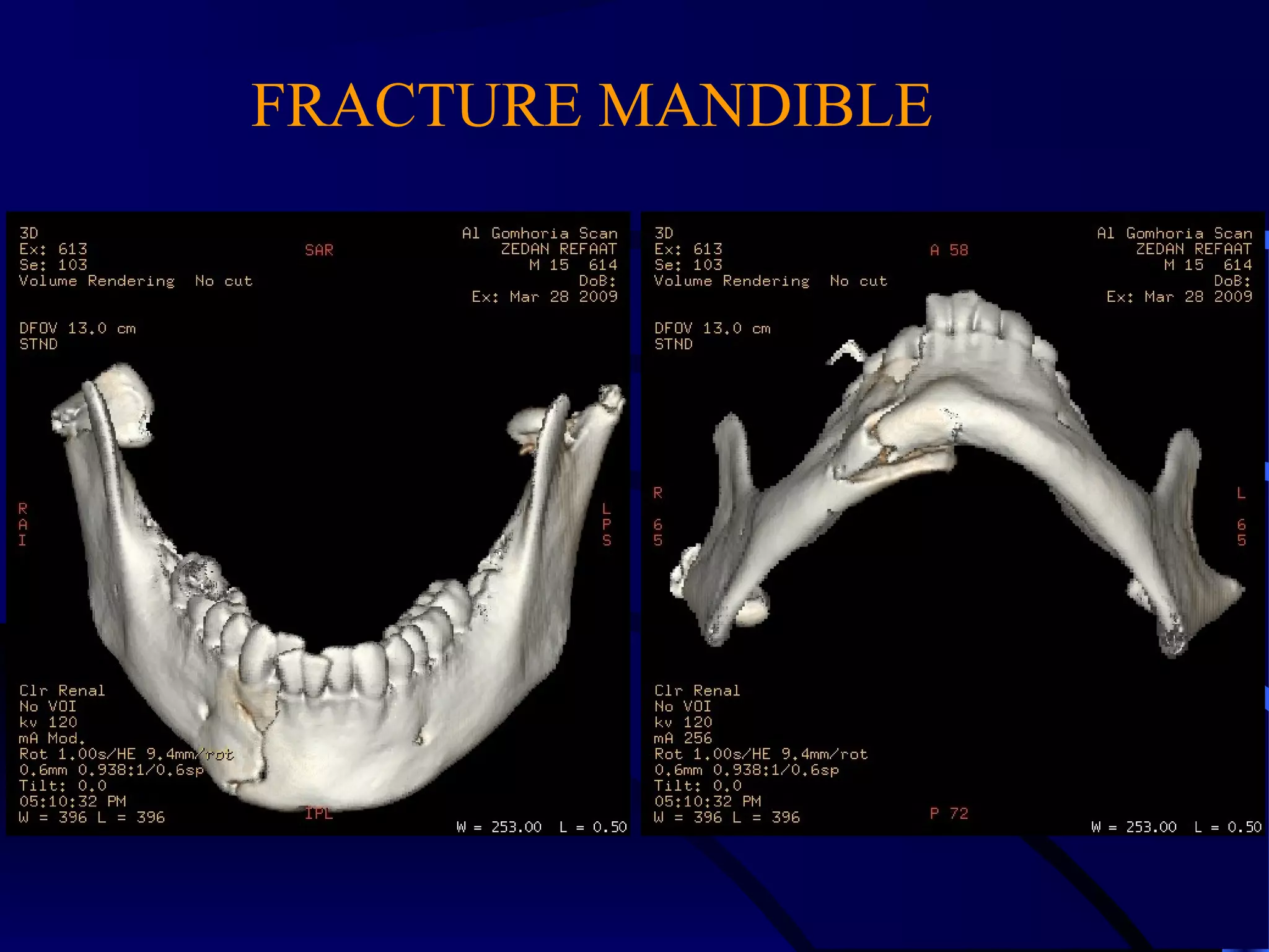 FRACTURE MANDIBLE
 