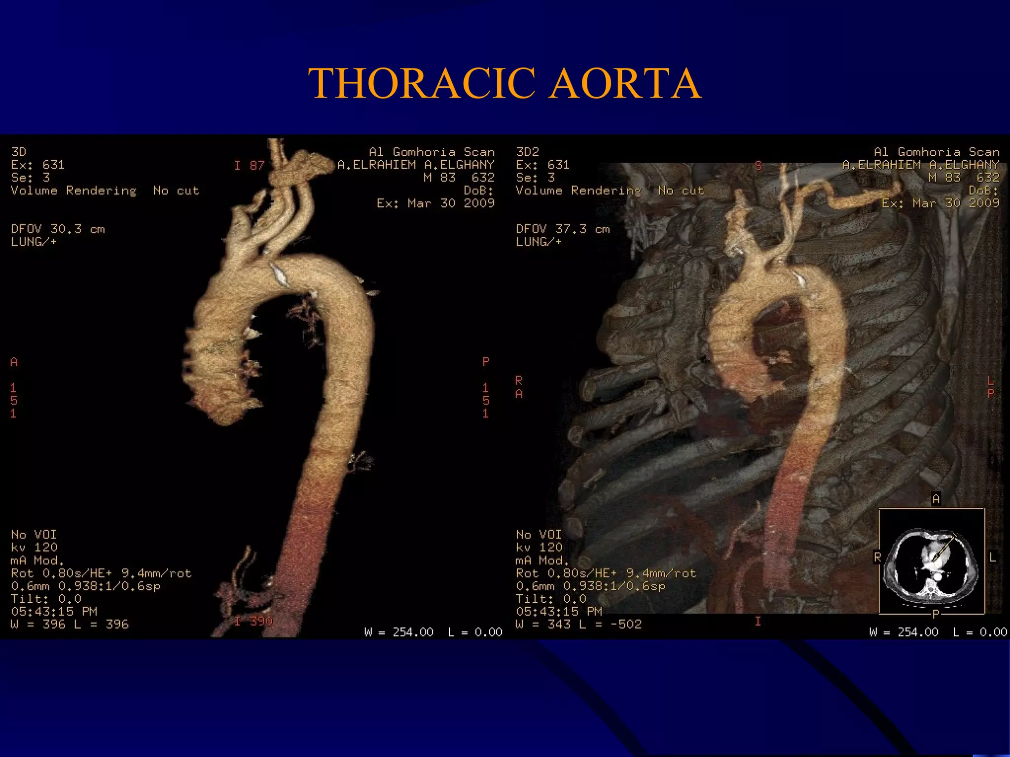 THORACIC AORTA
 
