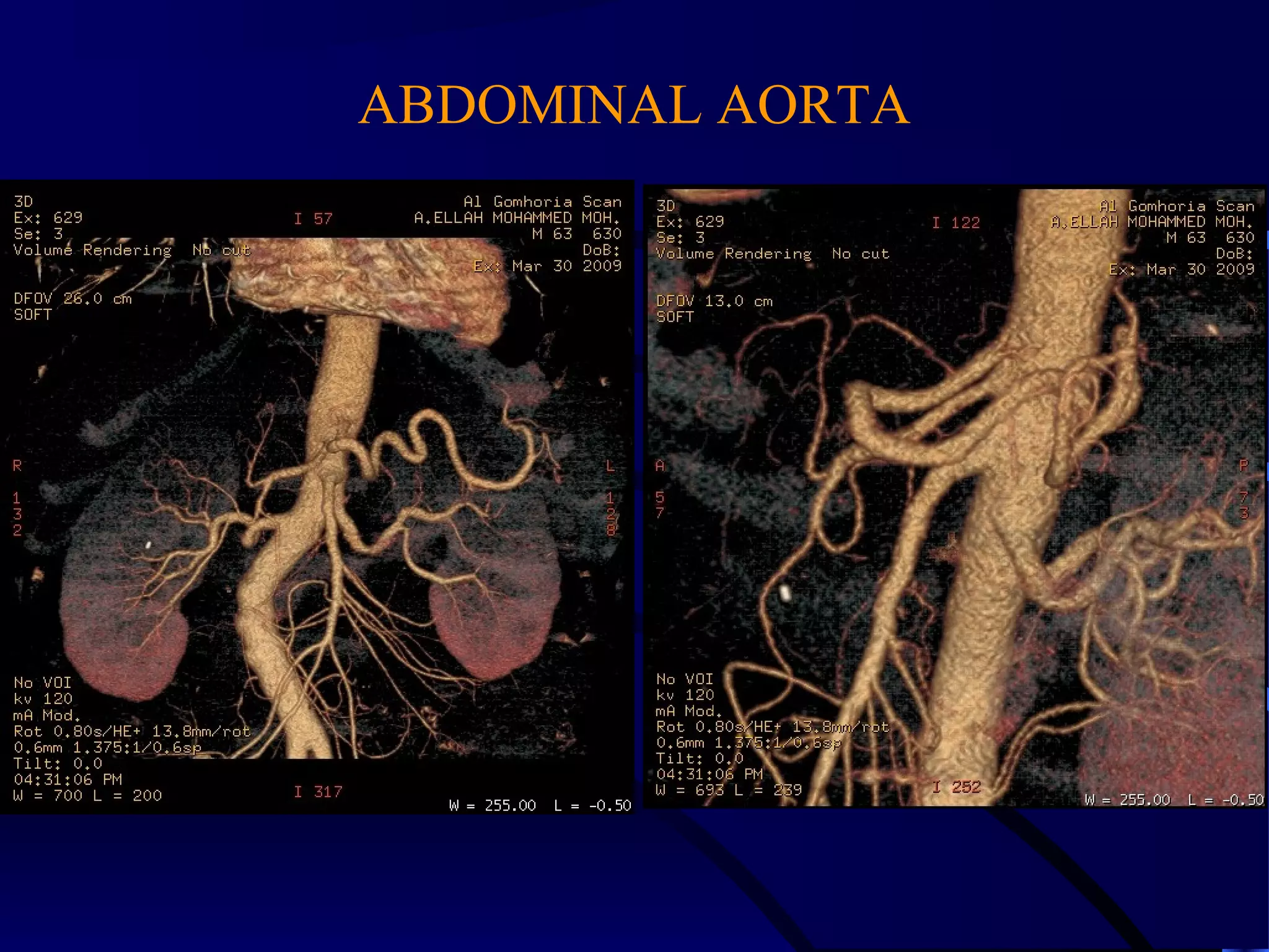 ABDOMINAL AORTA
 