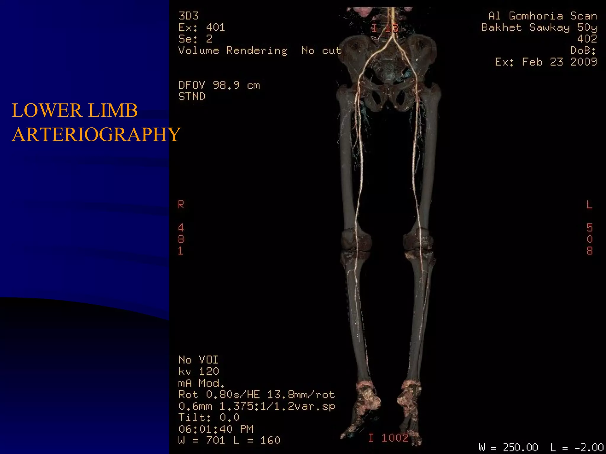 LOWER LIMB
ARTERIOGRAPHY
 