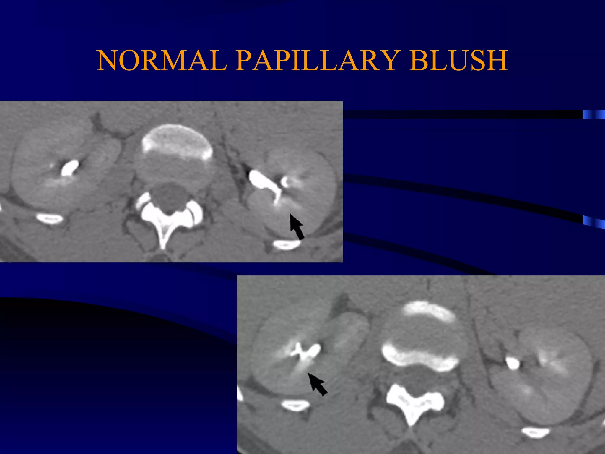 NORMAL PAPILLARY BLUSH
 