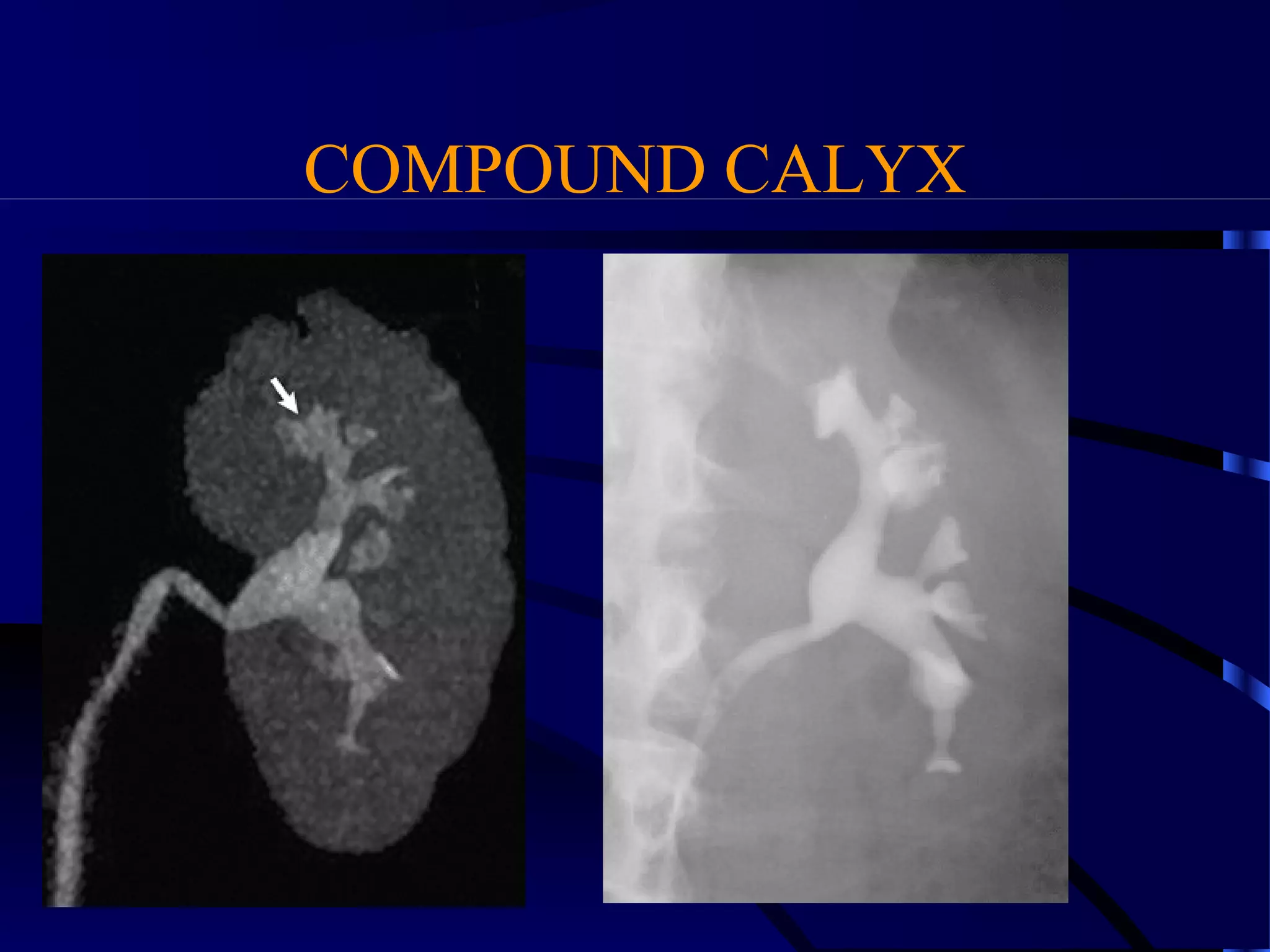 COMPOUND CALYX
 
