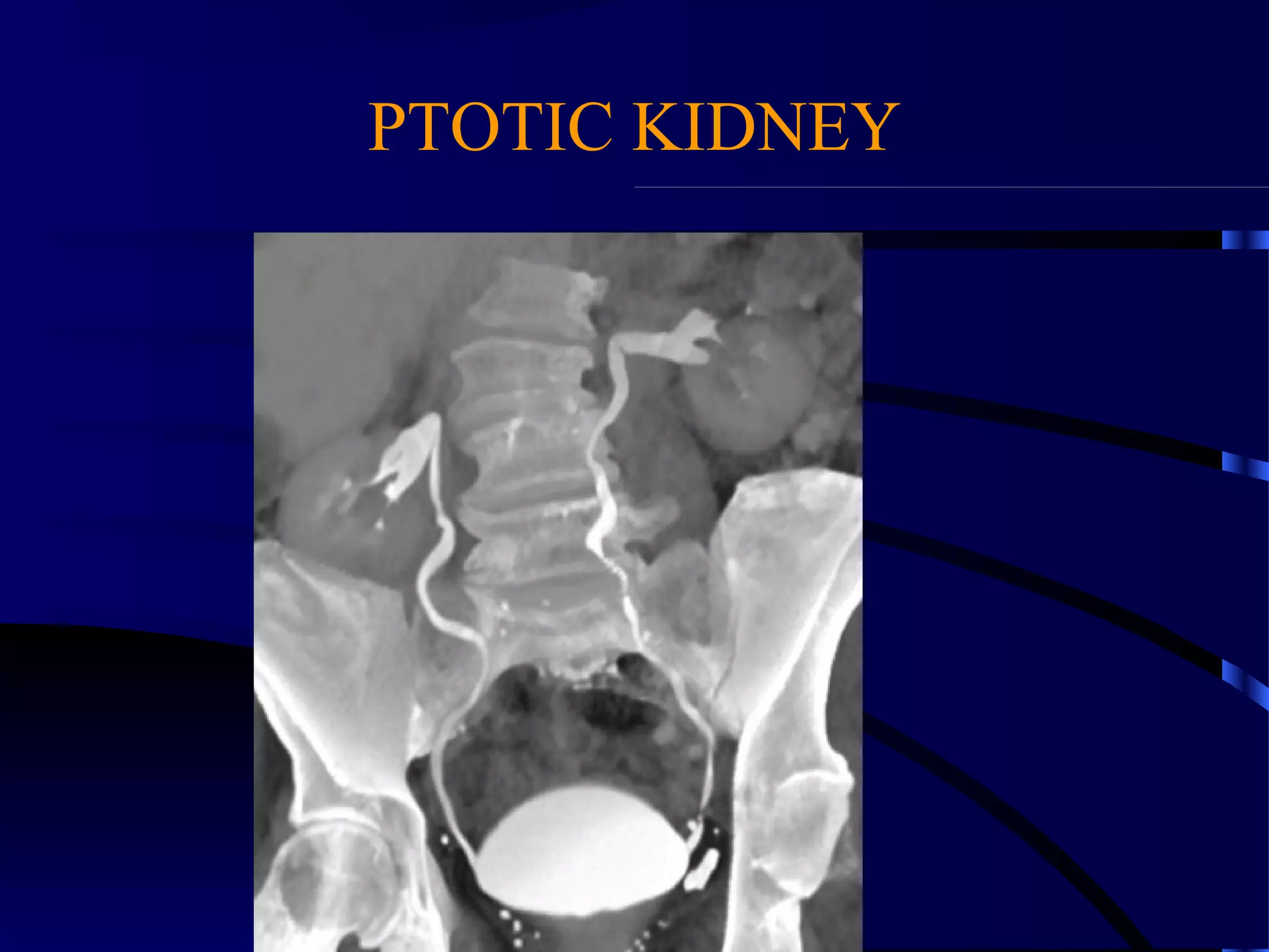 PTOTIC KIDNEY
 