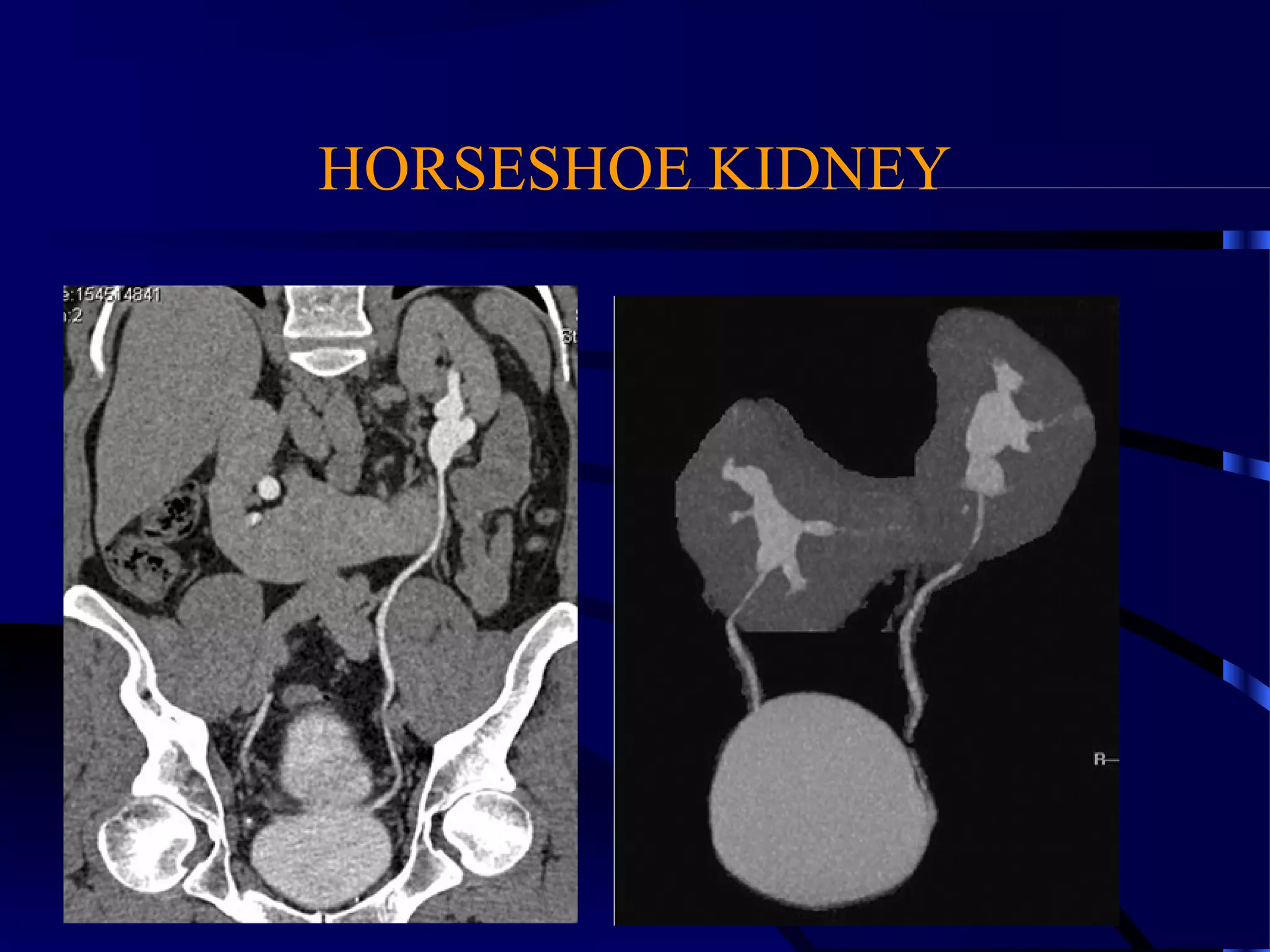 HORSESHOE KIDNEY
 