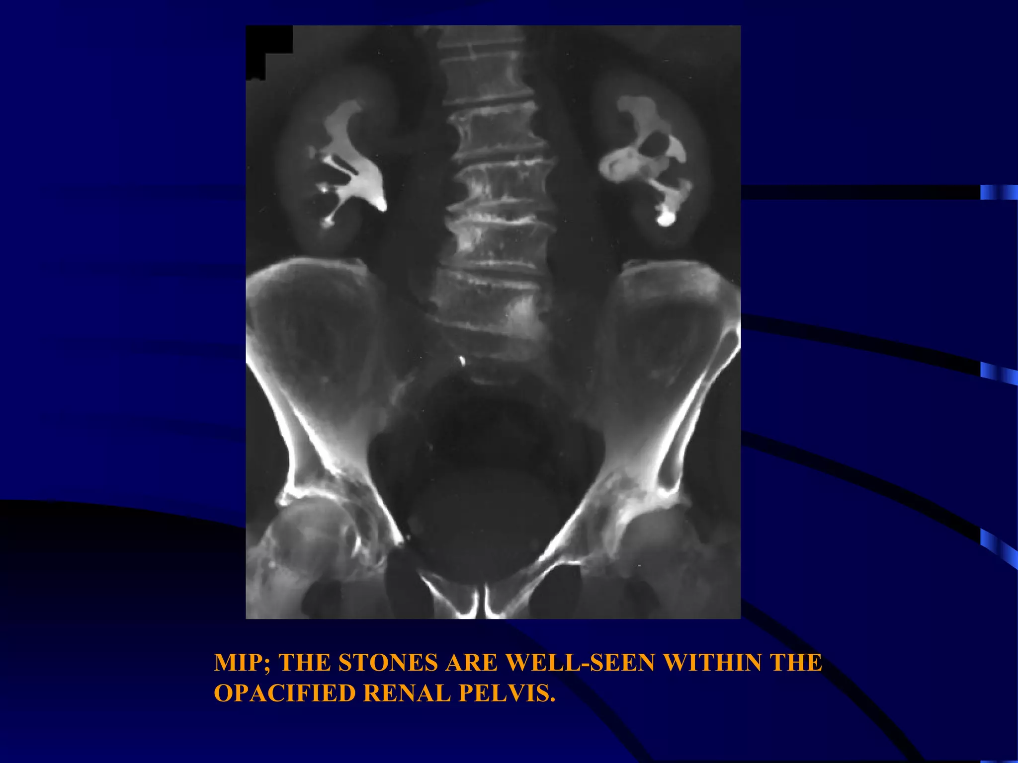 MIP; THE STONES ARE WELL-SEEN WITHIN THE
OPACIFIED RENAL PELVIS.
 