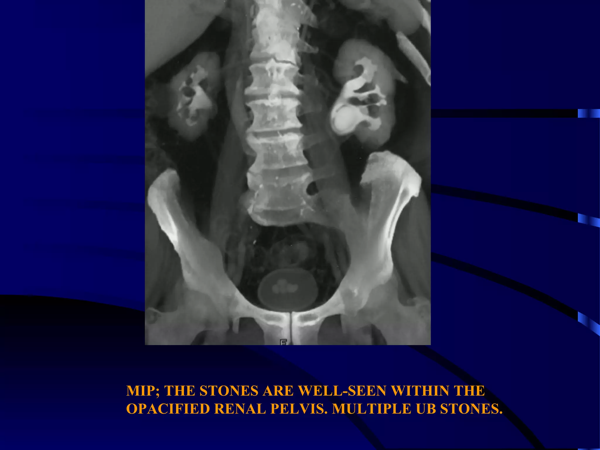 MIP; THE STONES ARE WELL-SEEN WITHIN THE
OPACIFIED RENAL PELVIS. MULTIPLE UB STONES.
 