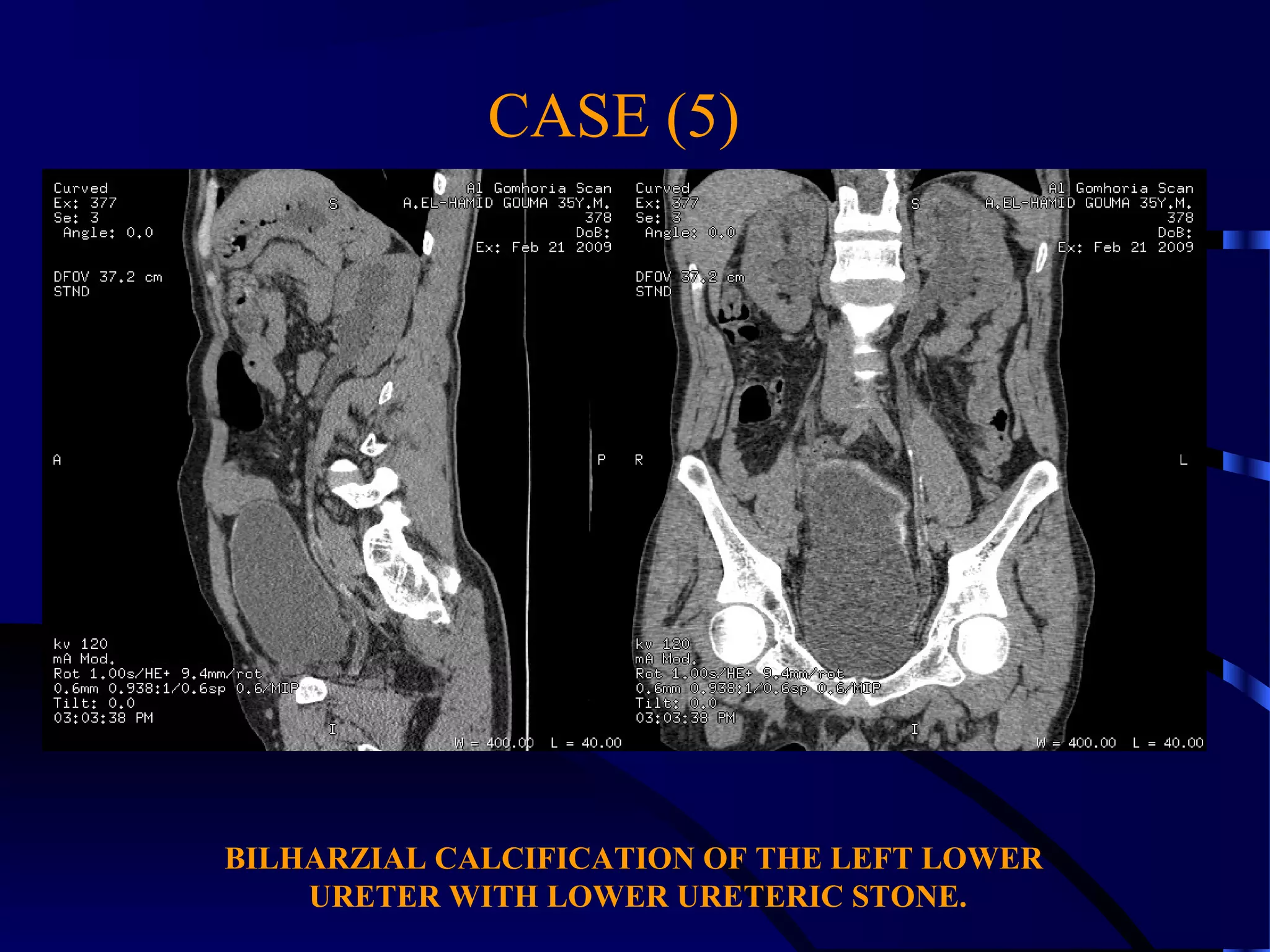 CASE (5)
BILHARZIAL CALCIFICATION OF THE LEFT LOWER
URETER WITH LOWER URETERIC STONE.
 