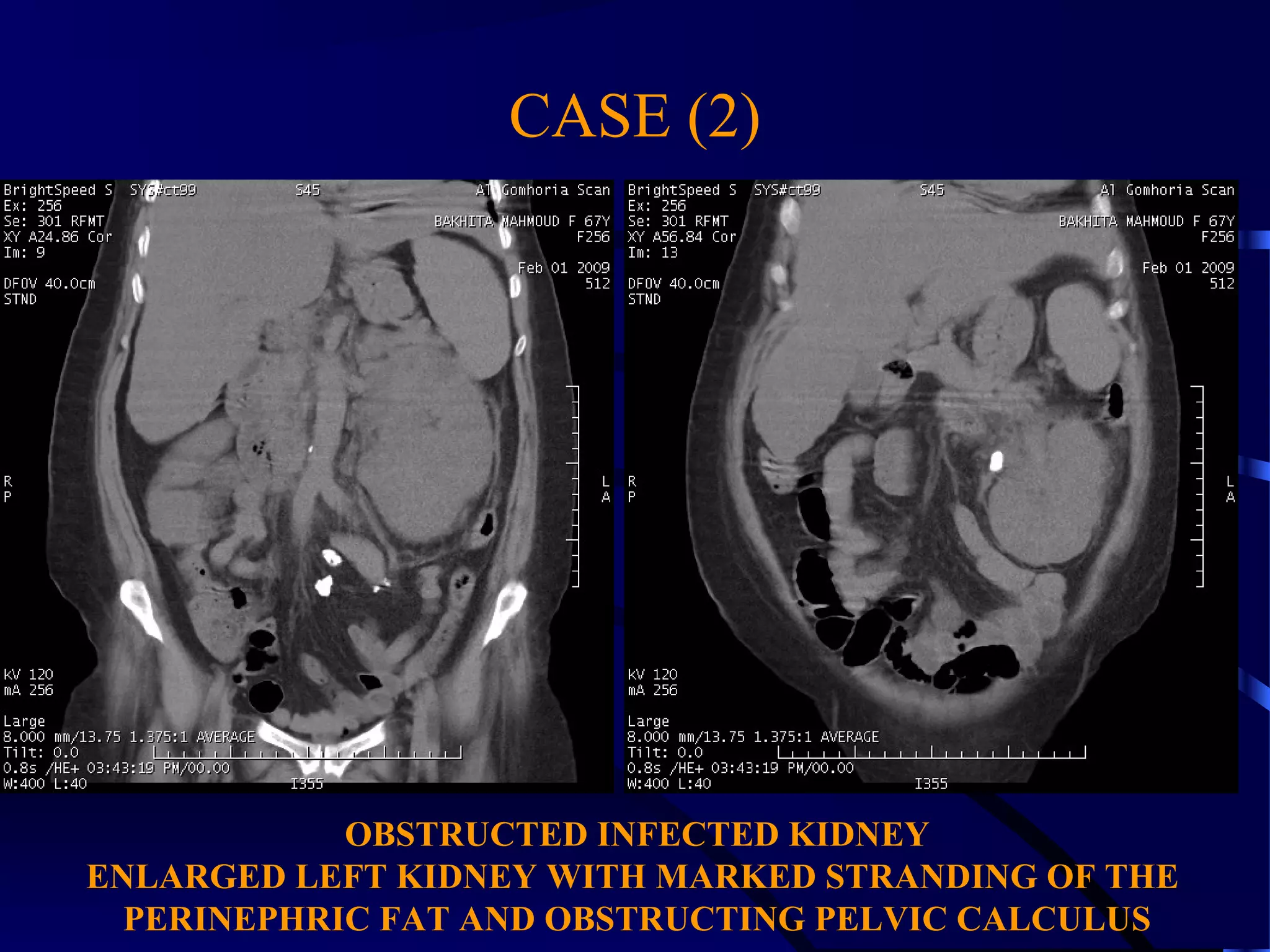 CASE (2)
OBSTRUCTED INFECTED KIDNEY
ENLARGED LEFT KIDNEY WITH MARKED STRANDING OF THE
PERINEPHRIC FAT AND OBSTRUCTING PELVIC CALCULUS
 