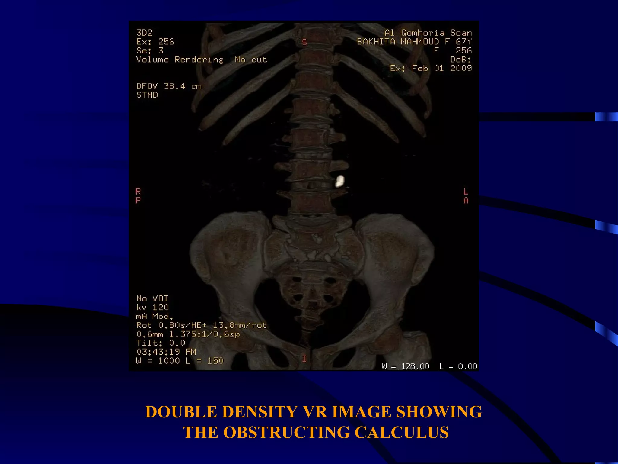 DOUBLE DENSITY VR IMAGE SHOWING
THE OBSTRUCTING CALCULUS
 