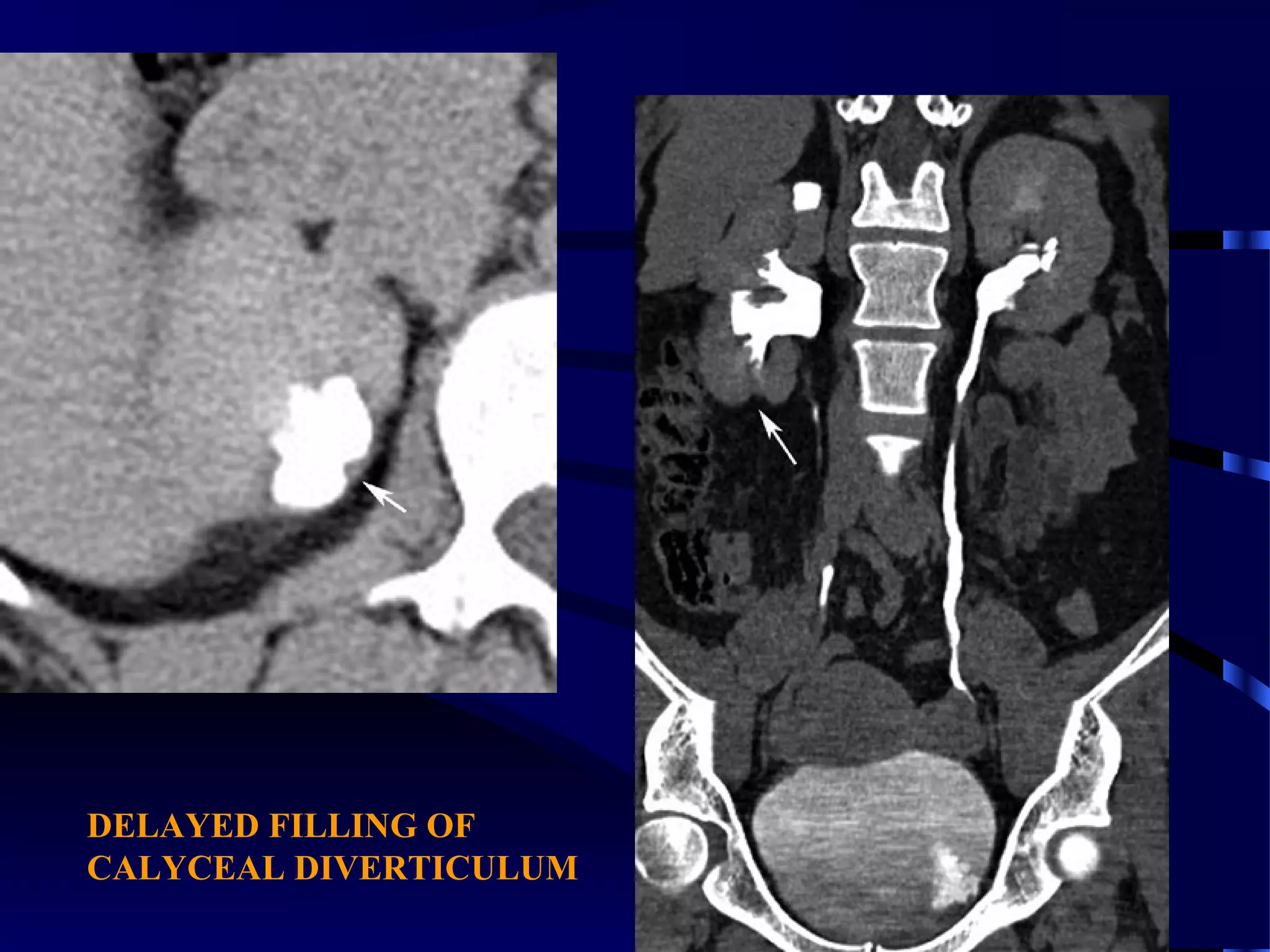 DELAYED FILLING OF
CALYCEAL DIVERTICULUM
 
