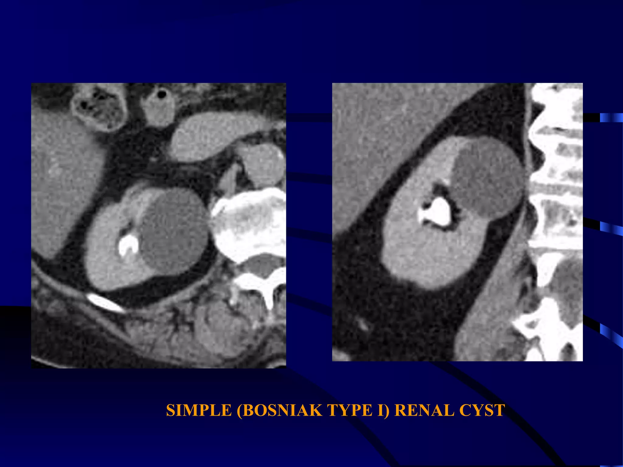 SIMPLE (BOSNIAK TYPE I) RENAL CYST
 