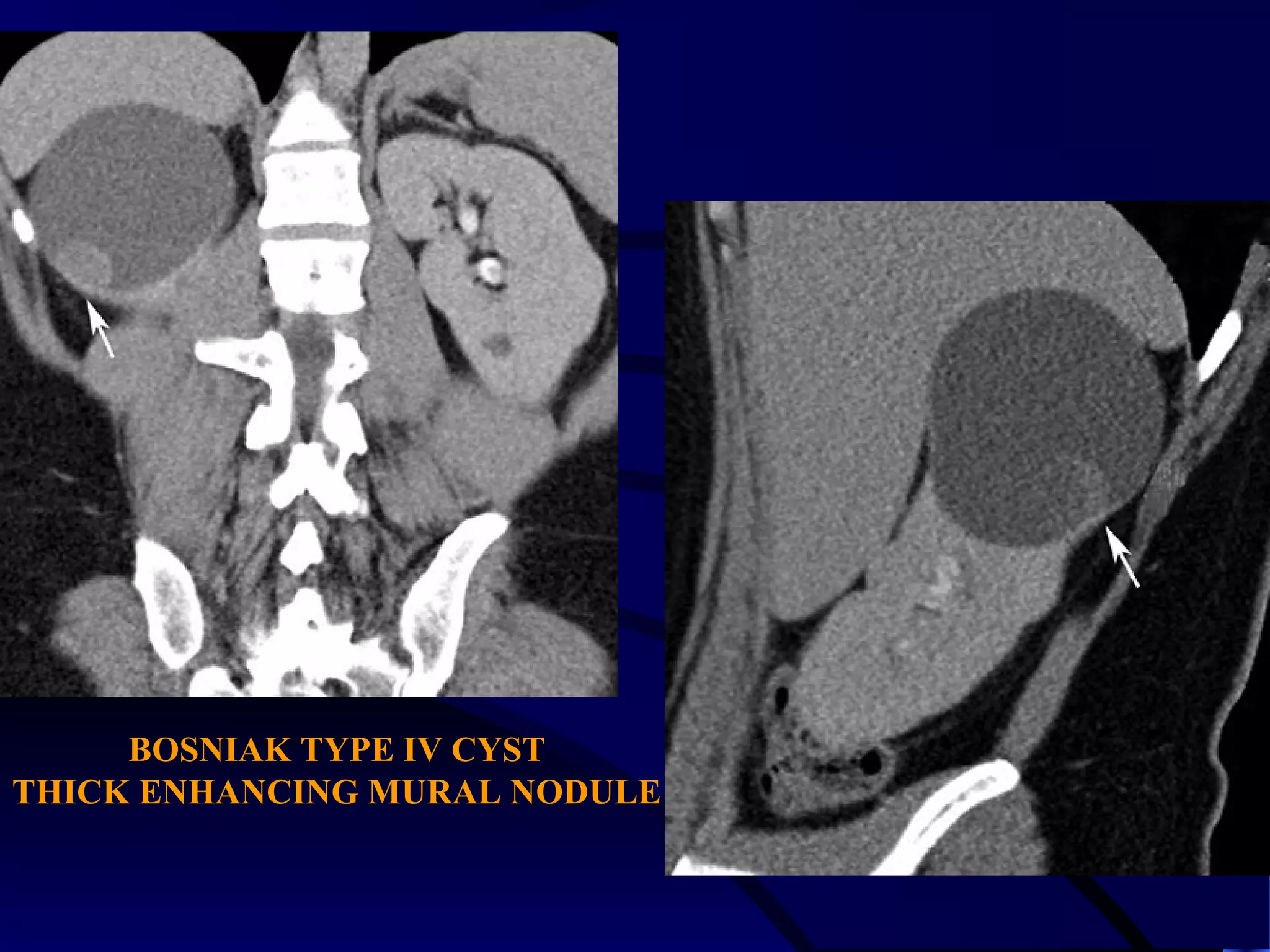 BOSNIAK TYPE IV CYST
THICK ENHANCING MURAL NODULE
 