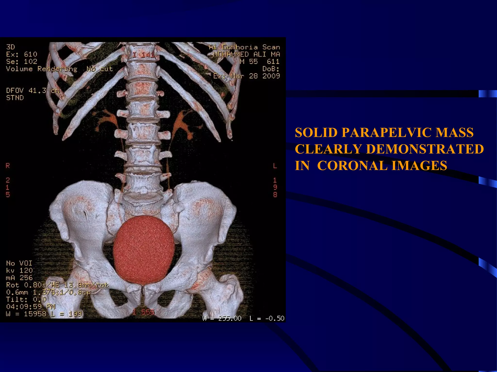 SOLID PARAPELVIC MASS
CLEARLY DEMONSTRATED
IN CORONAL IMAGES
 