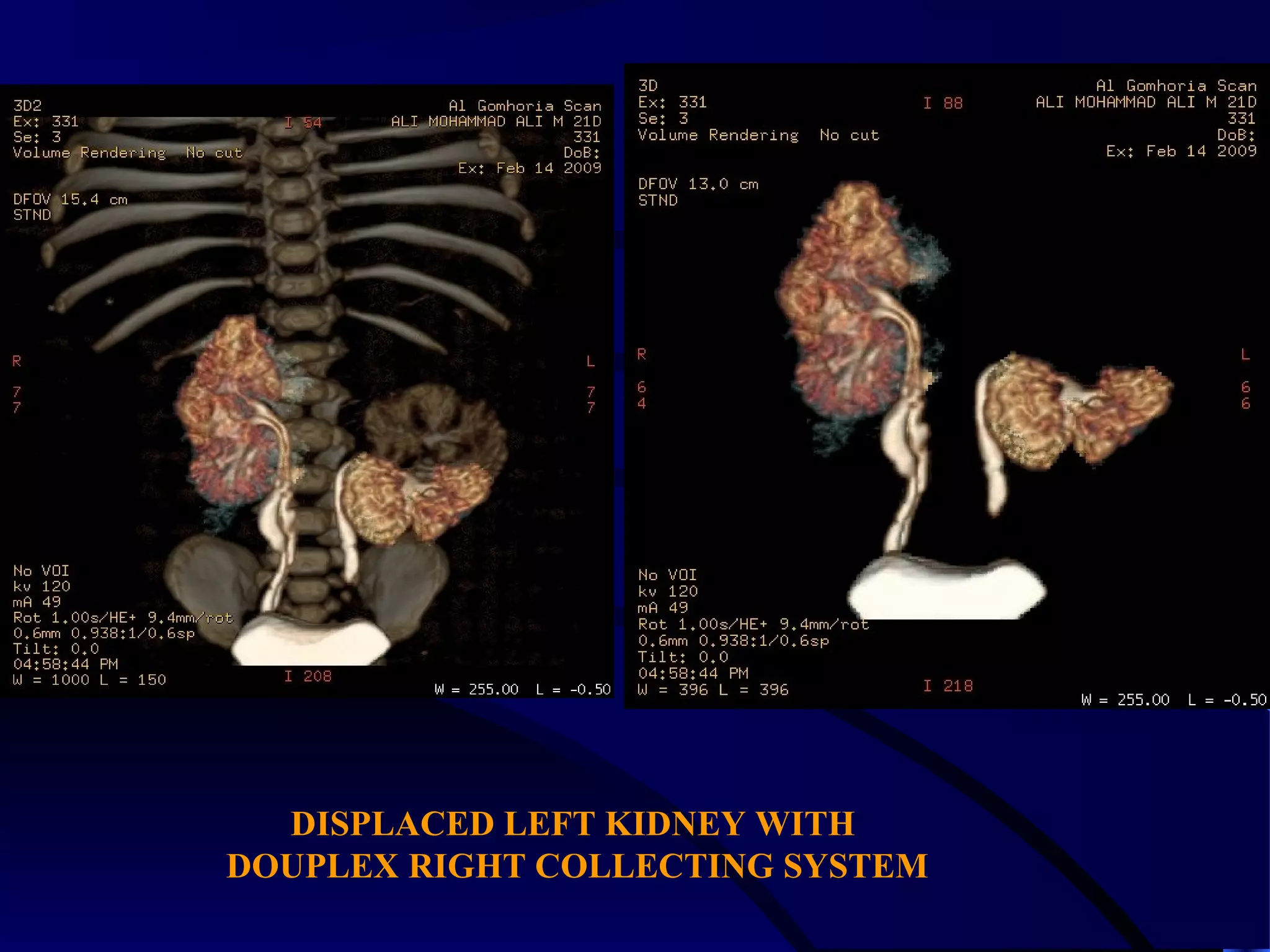 DISPLACED LEFT KIDNEY WITH
DOUPLEX RIGHT COLLECTING SYSTEM
 