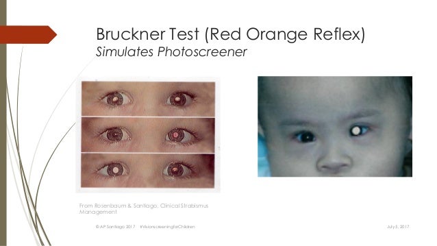 test eye 20/30 for #StopLookandListen Screening Children, Vision