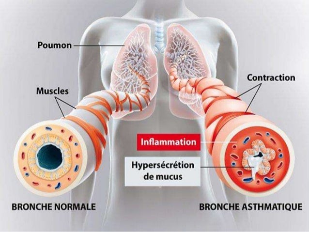 Quest-ce Qui Déclenche Une Crise De Fibromyalgie Médicaments de l'asthme