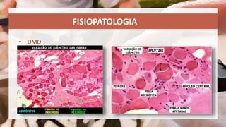 Distrofia Muscular de Duchenne | PPTX