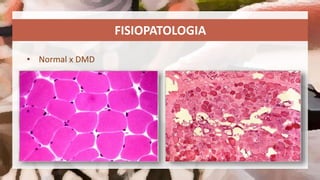 Distrofia Muscular de Duchenne | PPTX