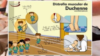 Distrofia Muscular de Duchenne | PPTX