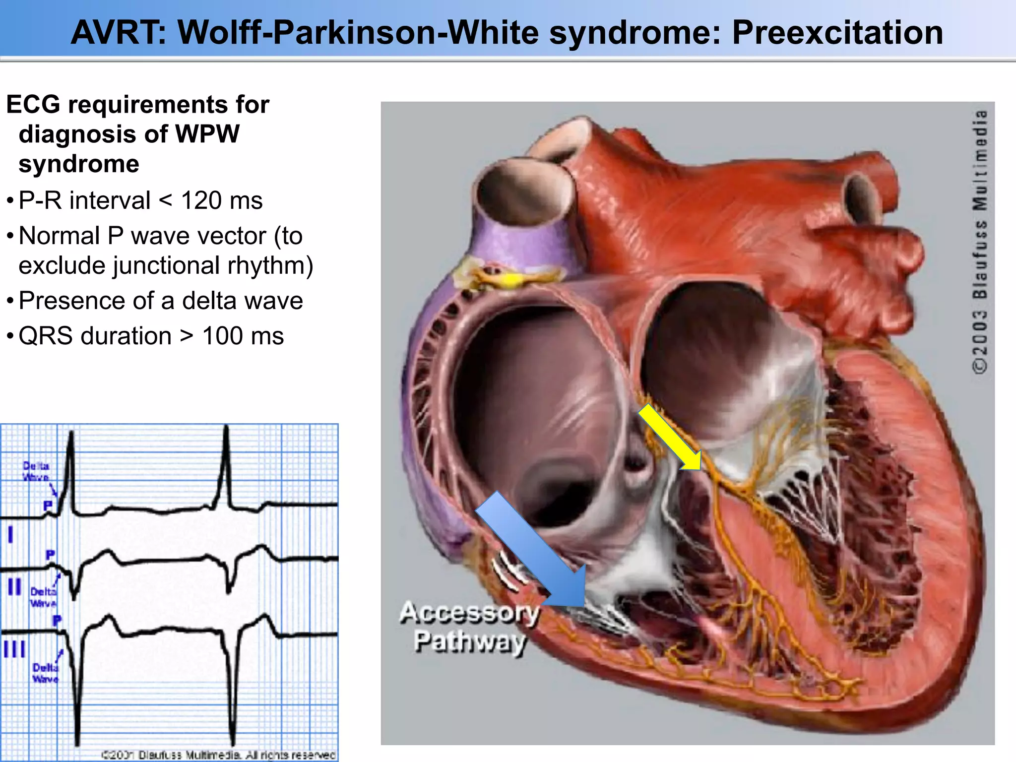 Síndrome de Wolff Parkinson-White | PDF