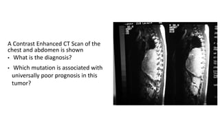 A Contrast Enhanced CT Scan of the
chest and abdomen is shown
• What is the diagnosis?
• Which mutation is associated with
universally poor prognosis in this
tumor?
 