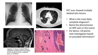 Sagittal T1 shows marked diffuse
cerebellar atrophy with no atrophy
of the cerebral cortex, midbrain,
pons, or medulla.
B
B
PET scan showed multiple
skeletal lytic lesions
• What is the most likely
complete diagnosis?
• Name the phenomenon
on HPE seen in this tumor
• For bonus +10 points,
next investigation based
on provided information?
 