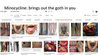 Minocycline: brings out the goth in you
 